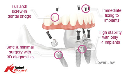 All-on-4 Same Day Implants diagram